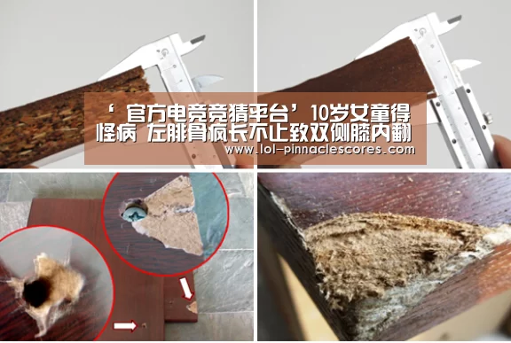 ‘ 官方电竞竞猜平台’10岁女童得怪病 左腓骨疯长不止致双侧膝内翻(图1) LOL英雄联盟投注